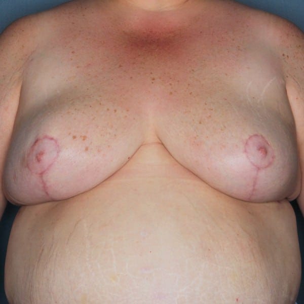 Mastopexy Patient 13 After - 1