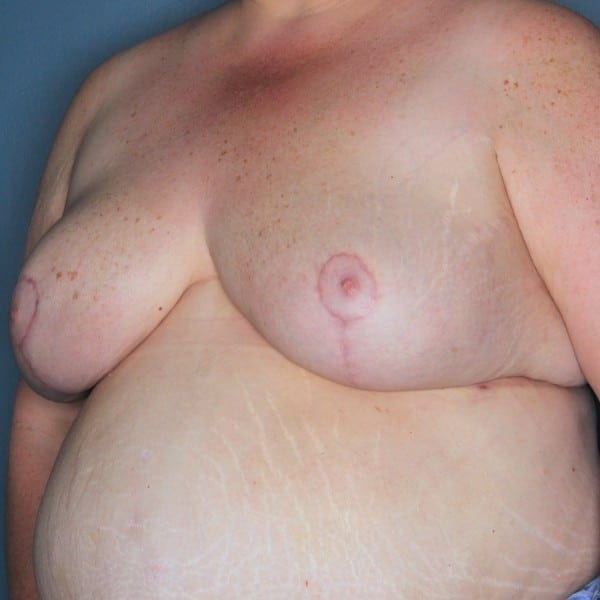 Mastopexy Patient 13 After - 2