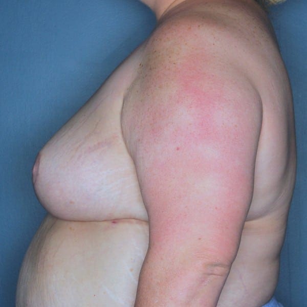 Mastopexy Patient 13 After - 3