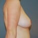 View Breast Reduction Patient 13 After - 3