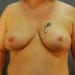 View Mastopexy Patient 15 After - 1