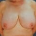 View Mastopexy Patient 16 Before - 1