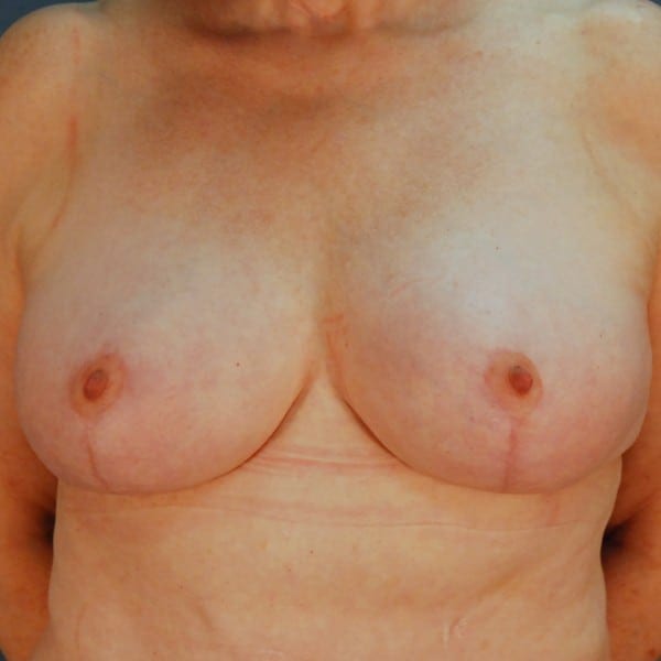 Mastopexy Patient 16 After - 1