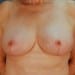 View Mastopexy Patient 16 After - 1