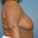 View Mastopexy Patient 17 Before - 3