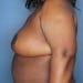 View Mastopexy Patient 17 After - 2