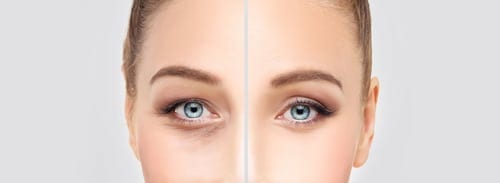 See More Clearly With Eyelid Surgery