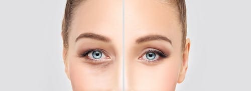 Lower Eyelid Blepharoplasty