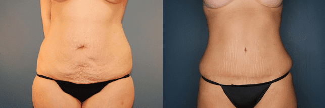 Before and After Tummy Tuck Surgery