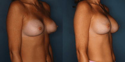 Breast Revision Before and After Photos