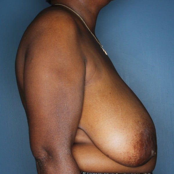 Breast Reduction Patient 24 Before - 3