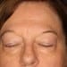 View Blepharoplasty Patient 02 Before - 3