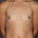View Breast Augmentation Patient 38 Before - 1