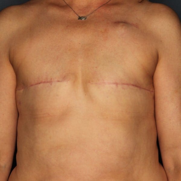 Implant-Based Reconstruction Patient 10 Before - 1