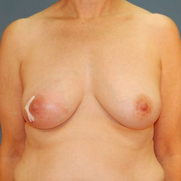 Implant-Based Reconstruction Patient 14 Before - 1