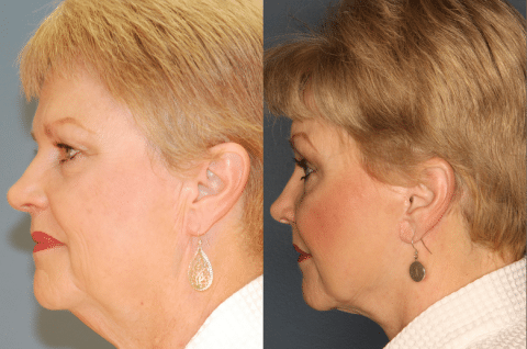 Before and After Facelift