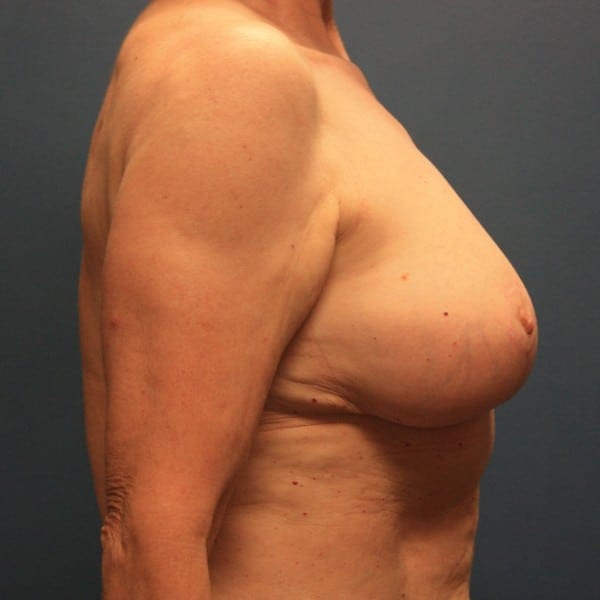 Mastopexy Patient 21 After - 3