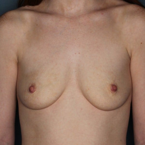 Breast Augmentation Patient 40 Before - 1