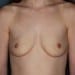 View Breast Augmentation Patient 40 Before - 1