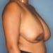 View Breast Reduction Patient 25 Before - 2