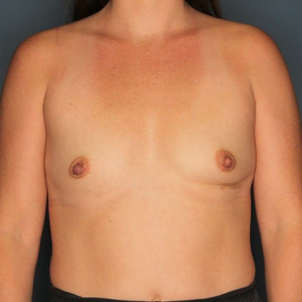 Breast Augmentation Patient 41 Before - 1