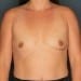 View Breast Augmentation Patient 41 Before - 1