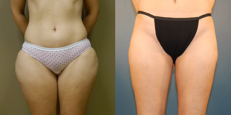 Cohn Liposuction Patient Before and After photos