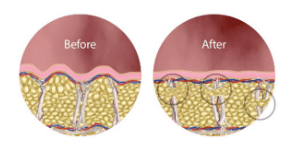 Fat Cell Before and Afters