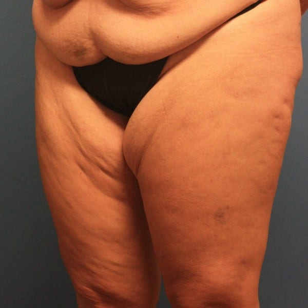 Thigh Lift Patient 01 Before - 2