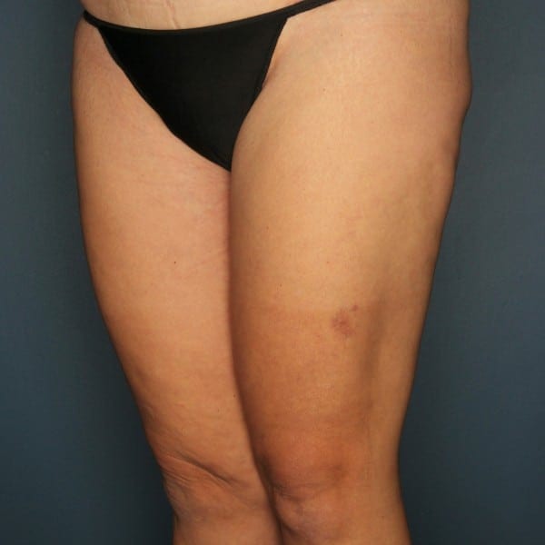 Thigh Lift Patient 01 After - 2