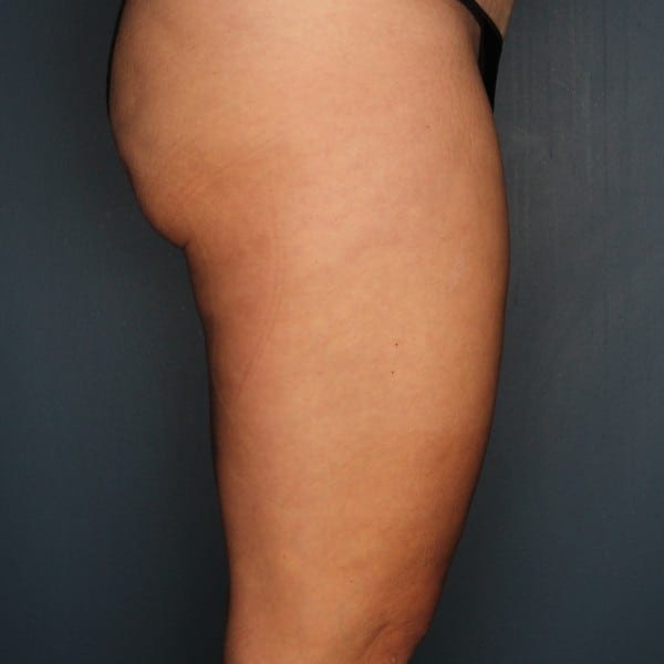 Thigh Lift Patient 01 After - 3