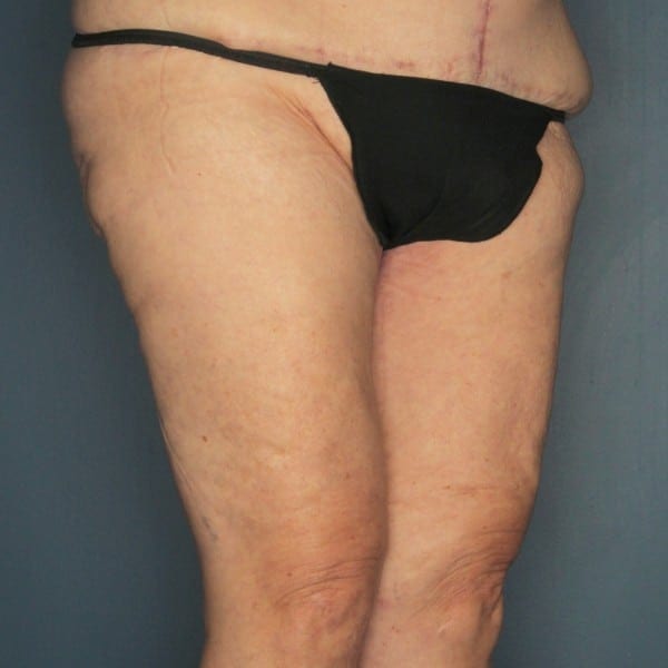 Thigh Lift Patient 02 After - 2