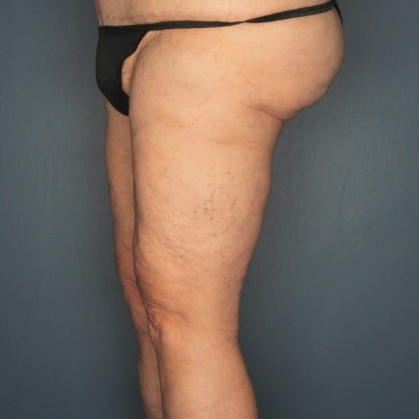 Thigh Lift Patient 02 After - 3