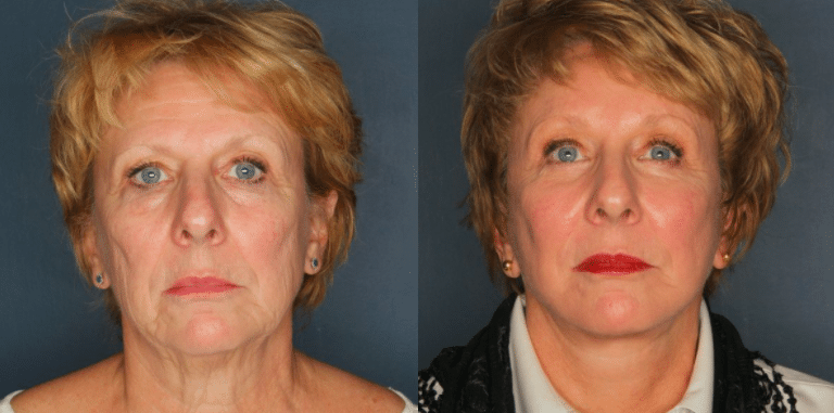 Cohn Facelift Patient 