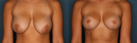 Al Cohn Breast Reduction Patient 3 months post surgery