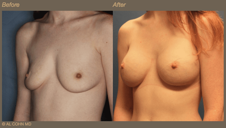 Dr. Cohn - B_A Breast Aug