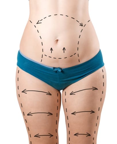 Tummy Tuck Alternative