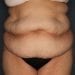 View Abdominoplasty Patient 12 Before - 1