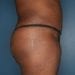 View Abdominoplasty Patient 17 After - 3