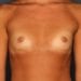 View Breast Augmentation Patient 4119 Before - 1