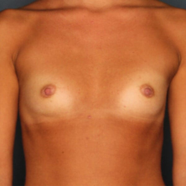 Breast Augmentation Patient 4119 Before - 1