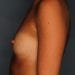 View Breast Augmentation Patient 4119 Before - 2