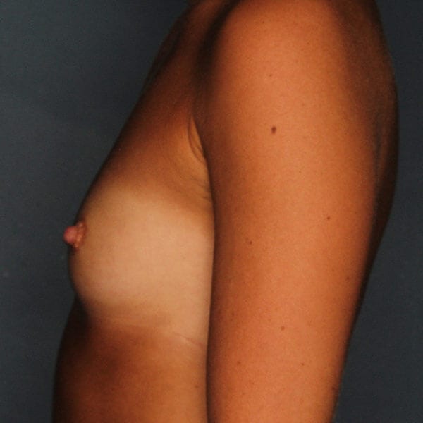 Breast Augmentation Patient 4119 Before - 2