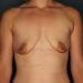 View Breast Augmentation Patient 4219 Before - 1