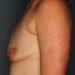 View Breast Augmentation Patient 4219 Before - 2