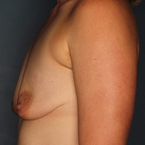 Breast Augmentation Patient 4219 Before - 2