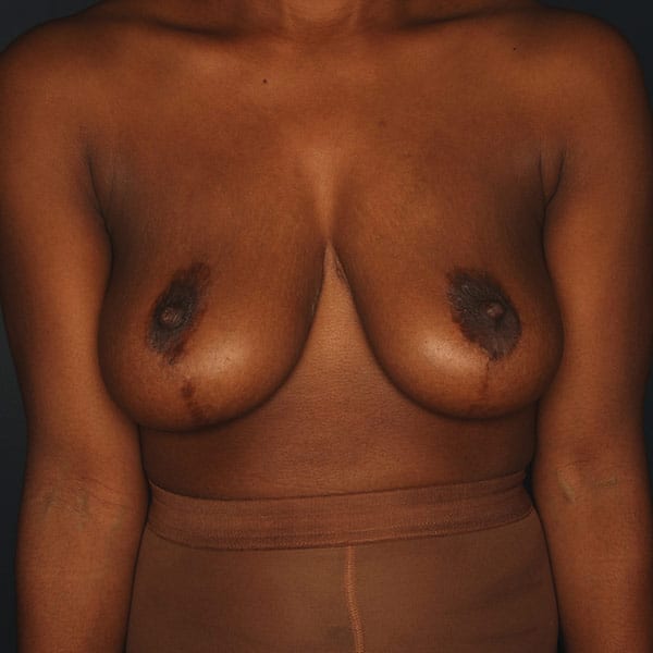 Breast Augmentation Patient 2619 Before - 1