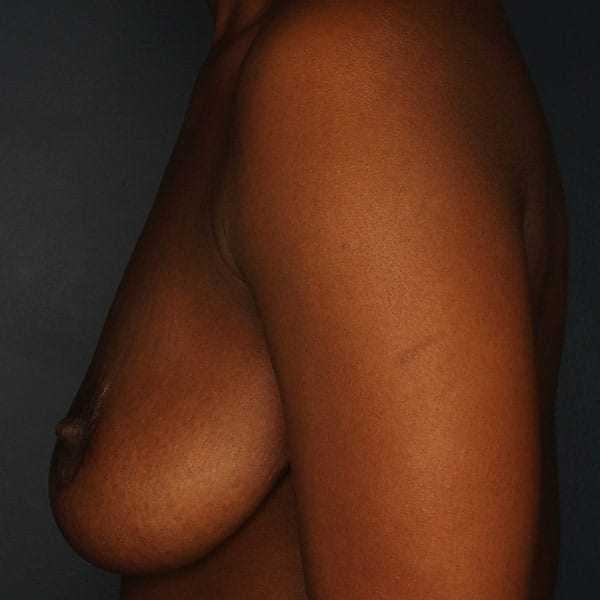 Breast Augmentation Patient 2619 Before - 2