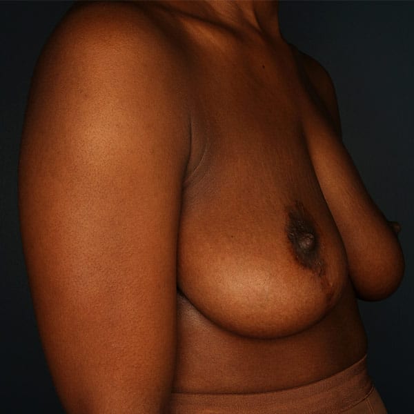 Breast Augmentation Patient 2619 Before - 3