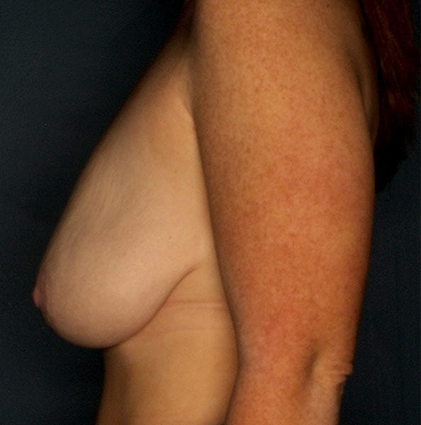 Breast Augmentation Patient 2719 Before - 2